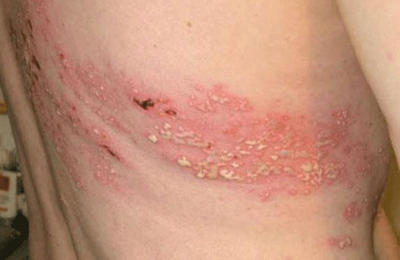 Phân biệt bệnh viêm da do tiếp xúc với côn trùng và bệnh Zona