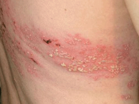Phân biệt bệnh viêm da do tiếp xúc với côn trùng và bệnh Zona